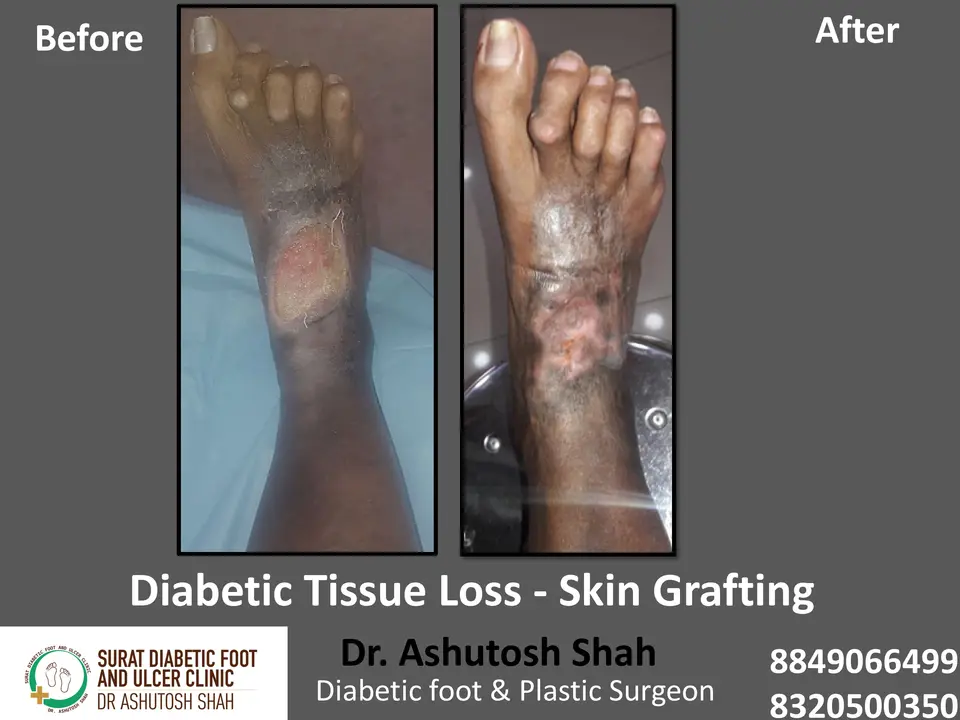 Diabetic Foot  PPT 3 checked by sir.pptx-77.webp